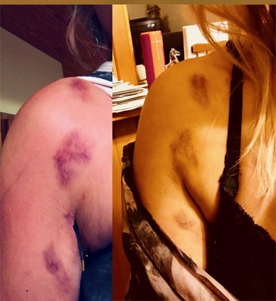 Shotgun bruises